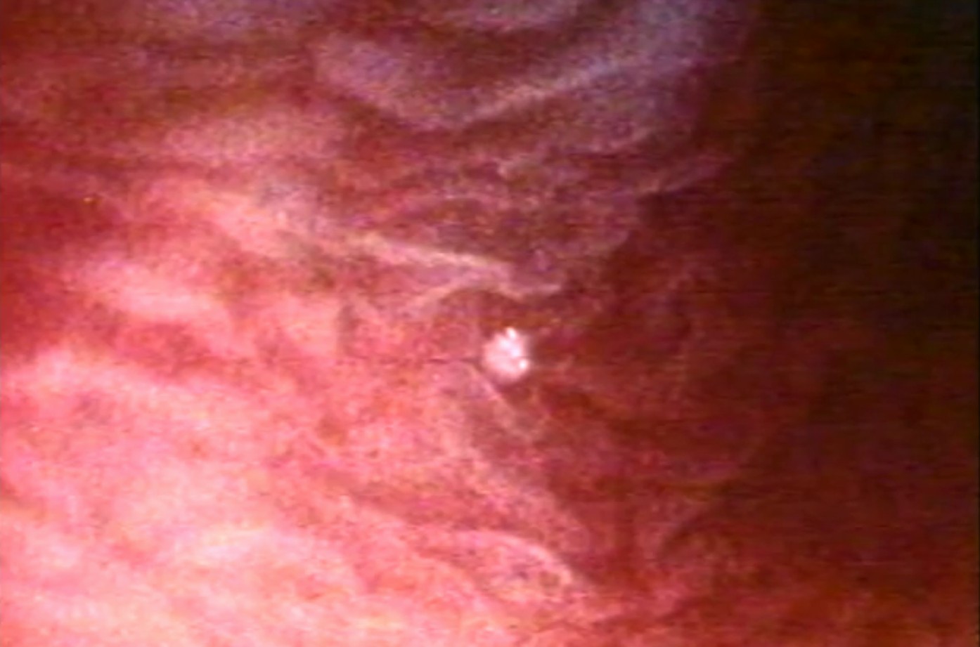 Morula nell'utero