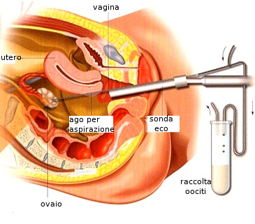 Prelievo degli ovociti