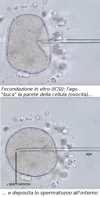fecondazione in vitro (ICSI)