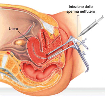 Inseminazione intra-uterina (IUI)